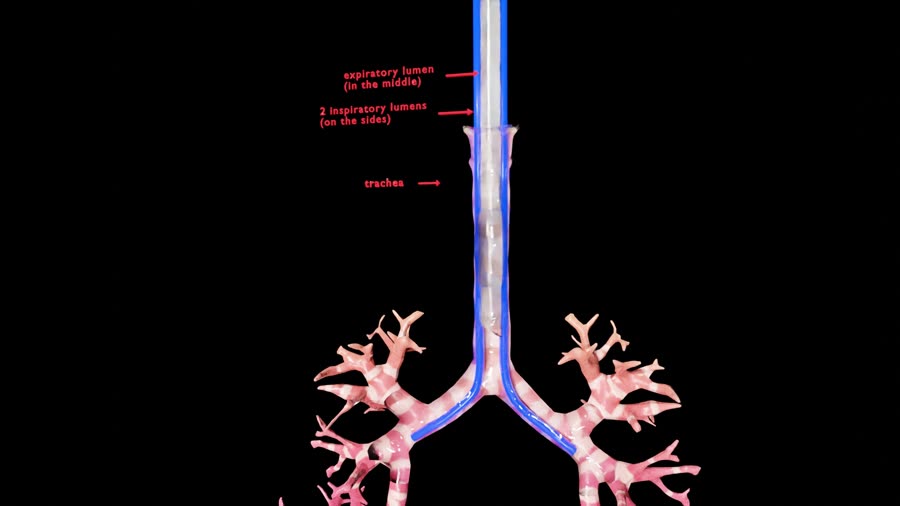 Render of the patented multi-lumen ventilation tube inside the trachea